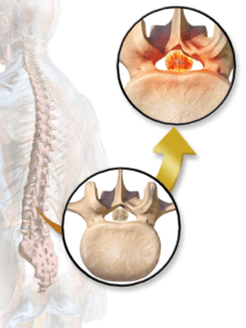 Spinal Stenosis Surgery