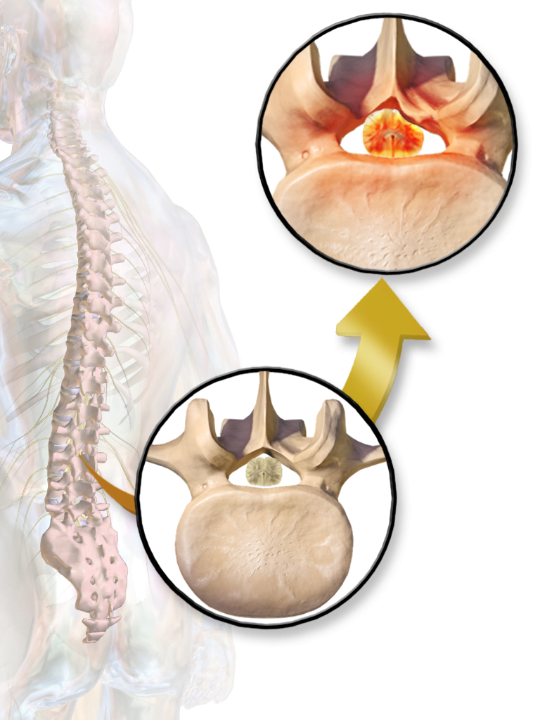 The Spinal Stenosis Surgery Innovated The Medical World